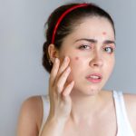 Acne treatment products online shopping made easy